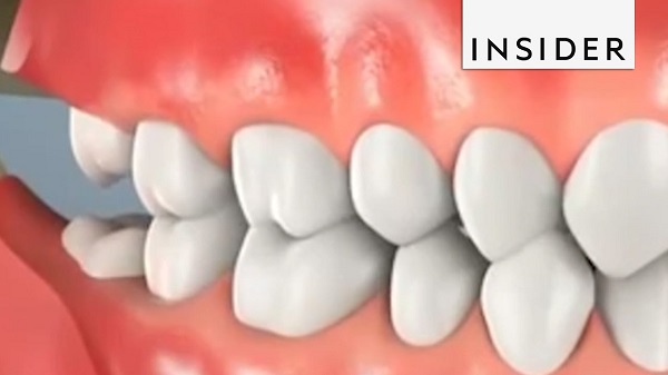 wisdom teeth