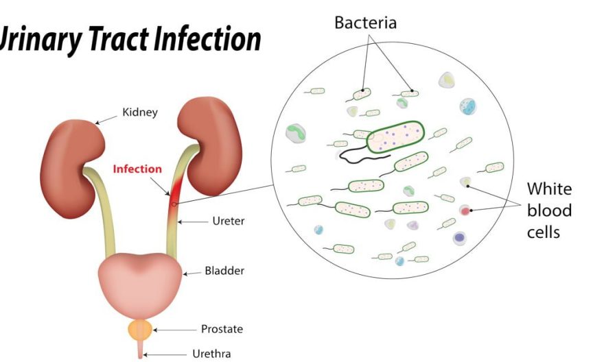 Urinary Tract Infection (UTI) Market